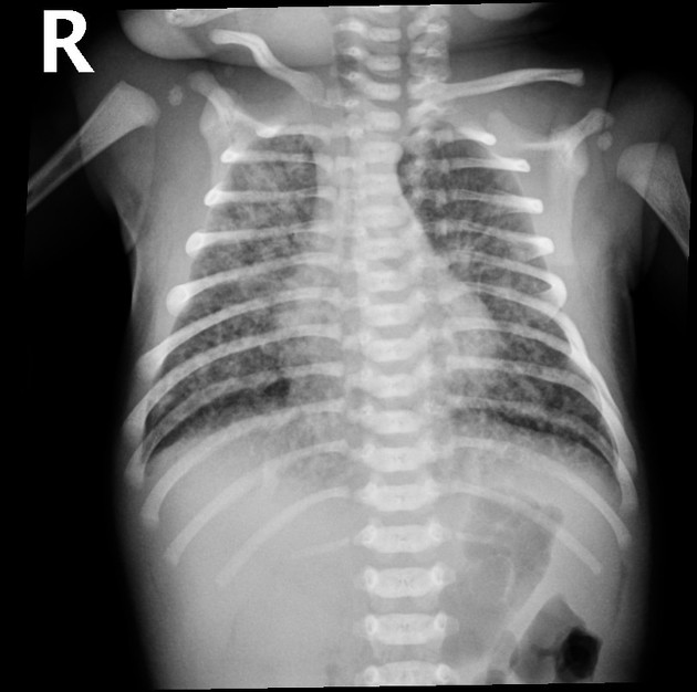 Neonatal chest X-ray in meconium aspiration syndrome: patchy coarse bilateral opacities with hyperinflation