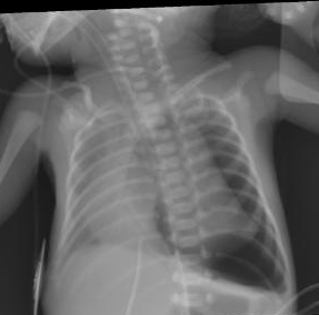 Neonatal chest X-ray showing a tension pneumothorax with contralateral mediastinal shift