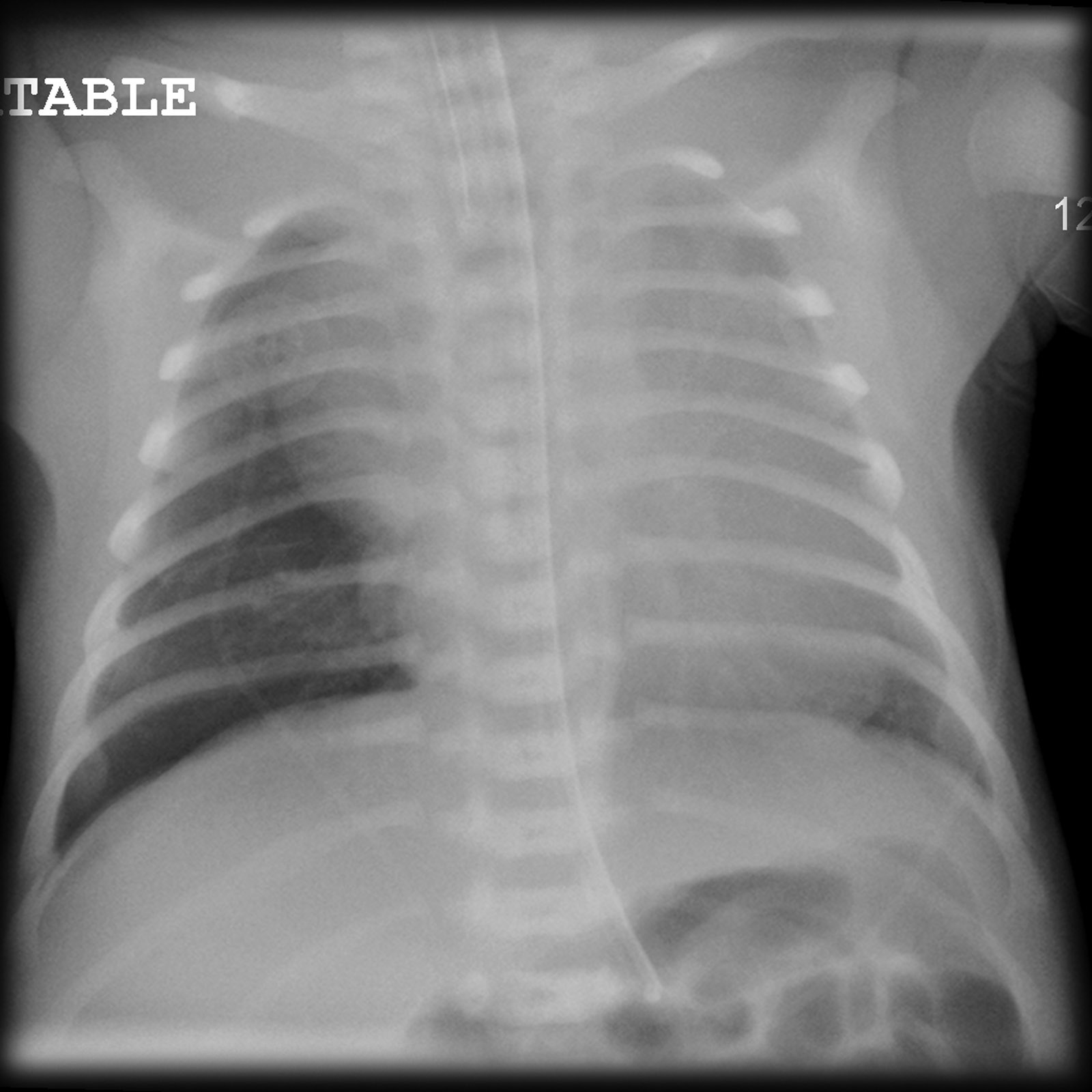 Neonatal chest X-ray showing a pneumothorax