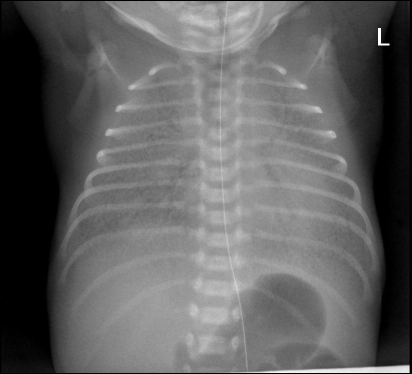 Neonatal chest X-ray in respiratory distress syndrome: diffuse ground-glass opacities, low lung volumes and air bronchograms