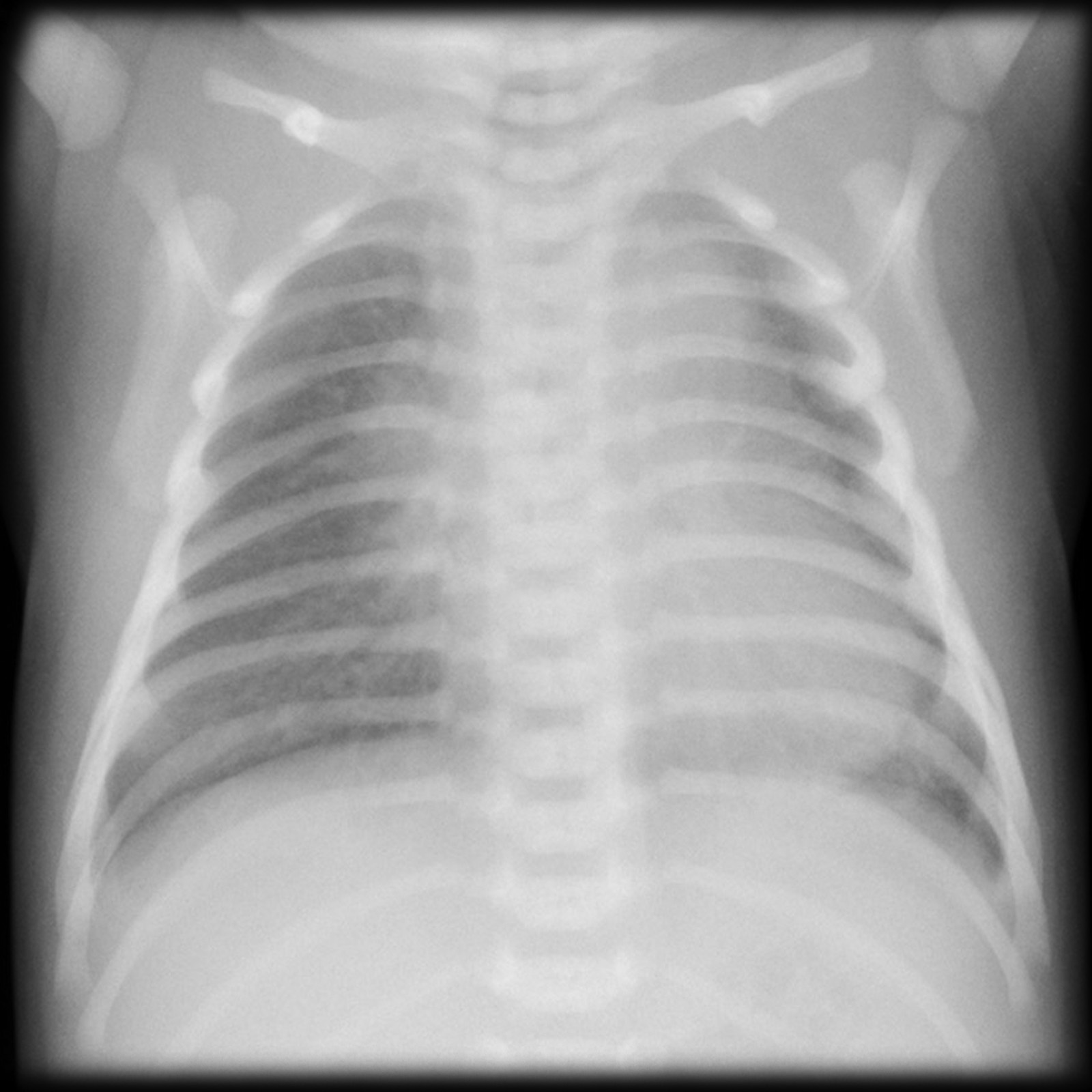Neonatal chest X-ray in transient tachypnoea of the newborn: prominent perihilar streaking with well-inflated lungs